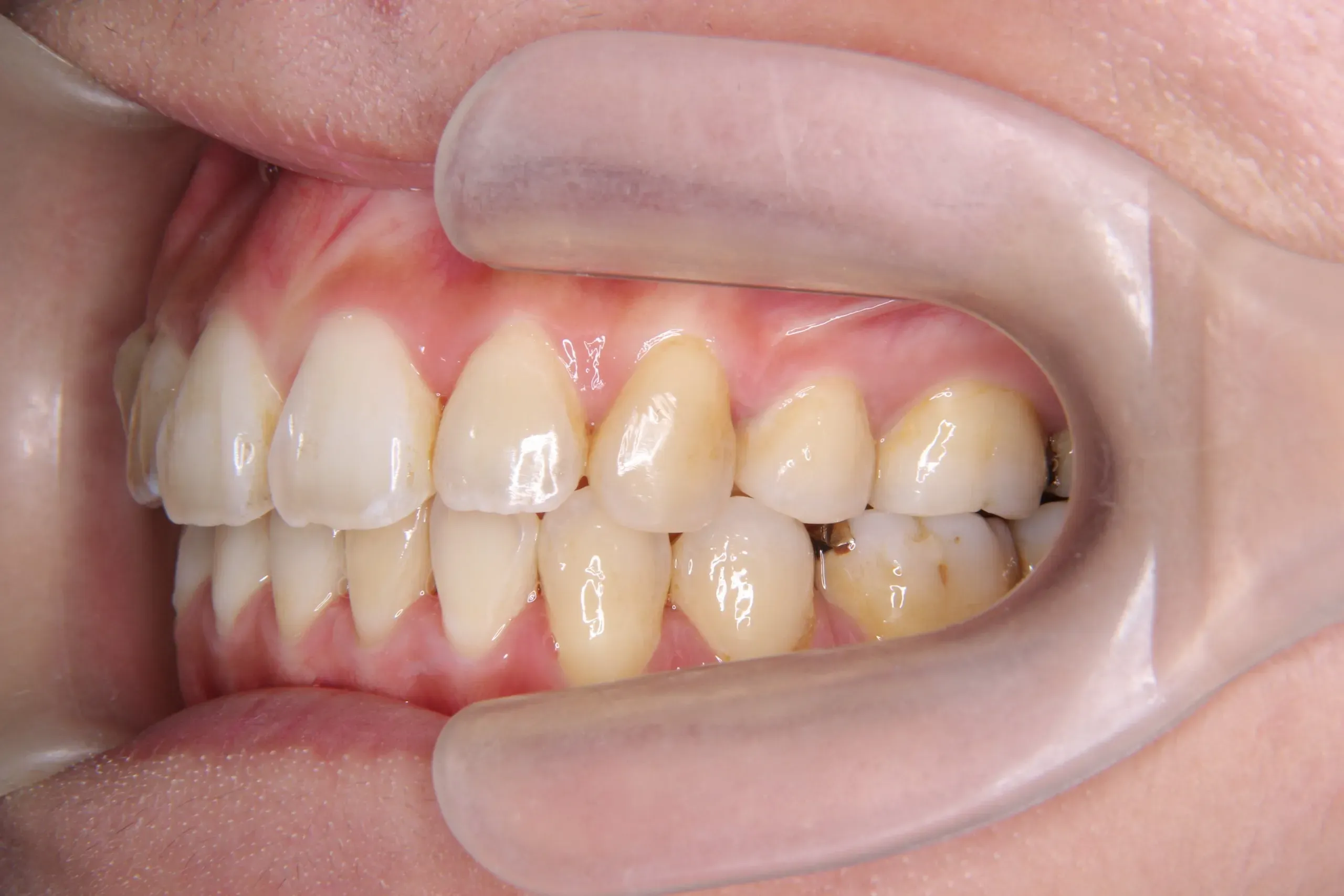 case20_出っ歯_after