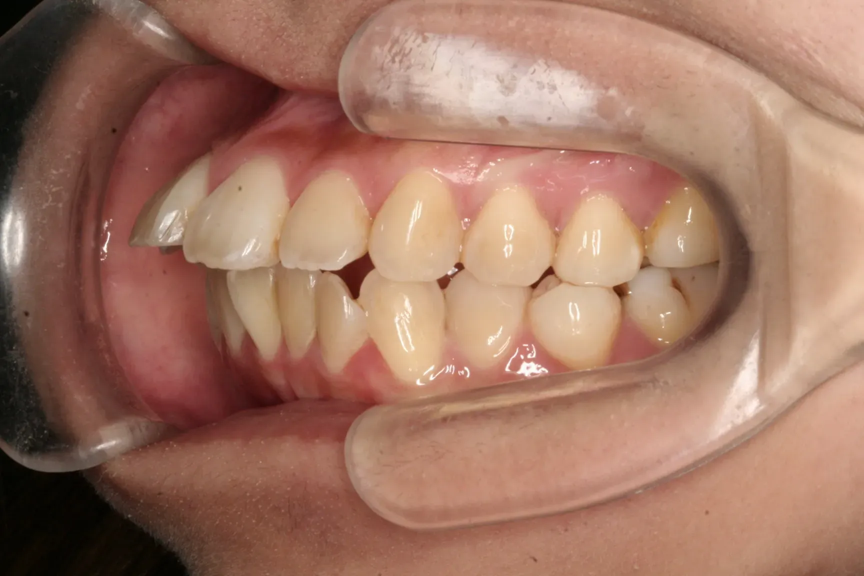 case20_出っ歯_before