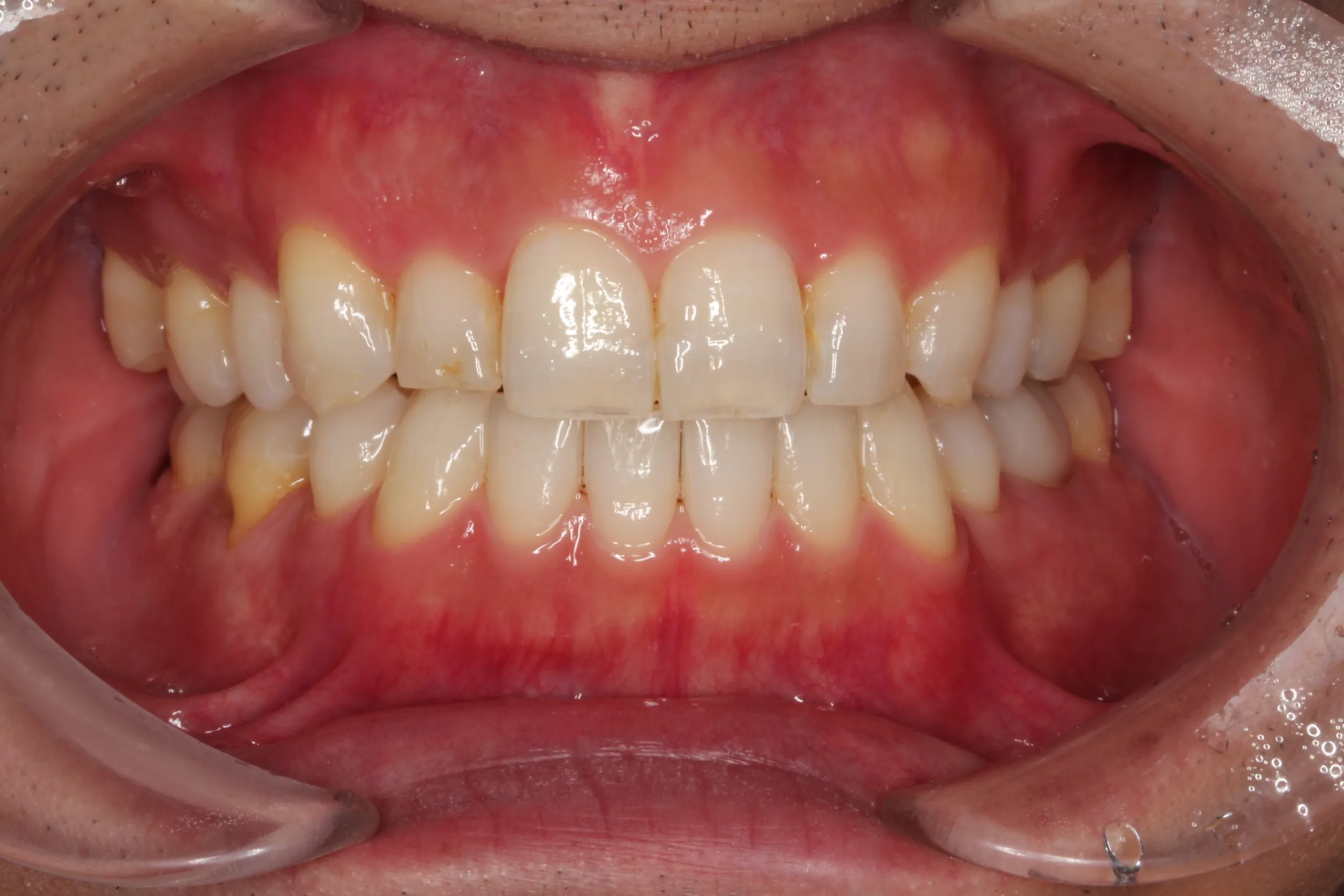 247M_A230_case23_歯の凹凸_after