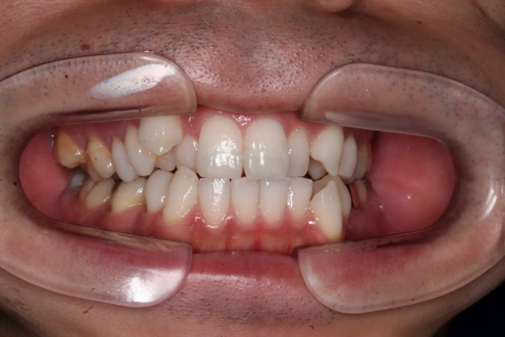 case23_歯の凹凸_before