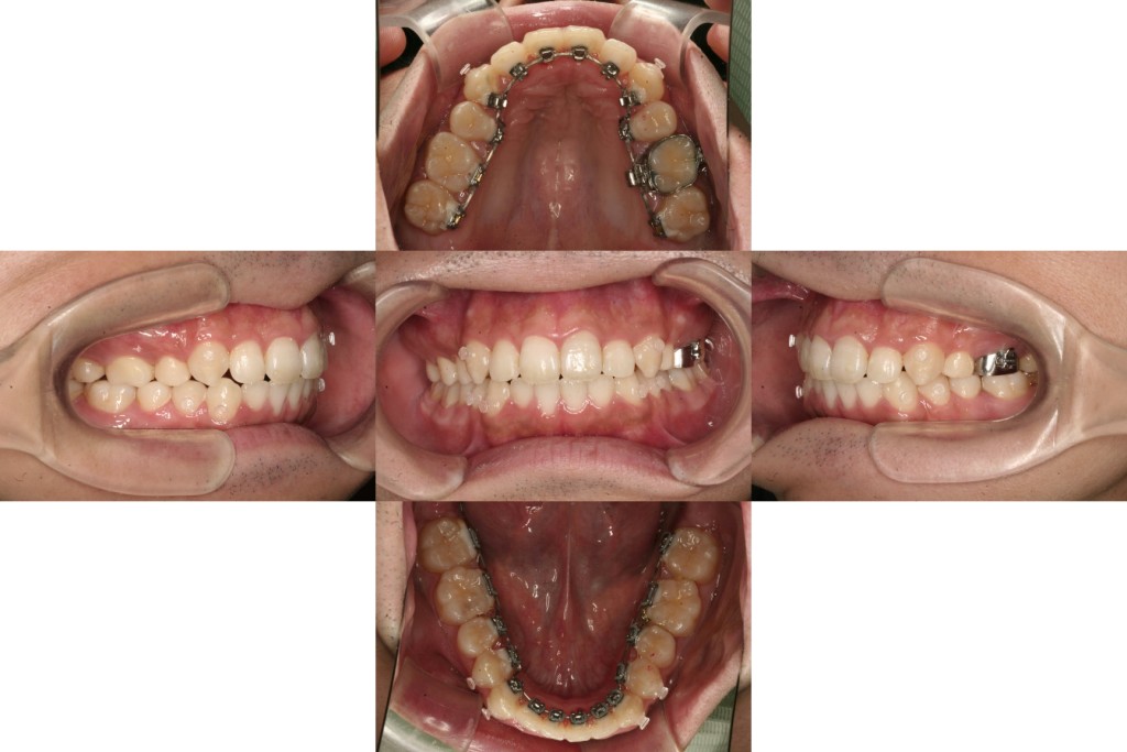 case15_出っ歯_1年3か月（上旬ごろ）