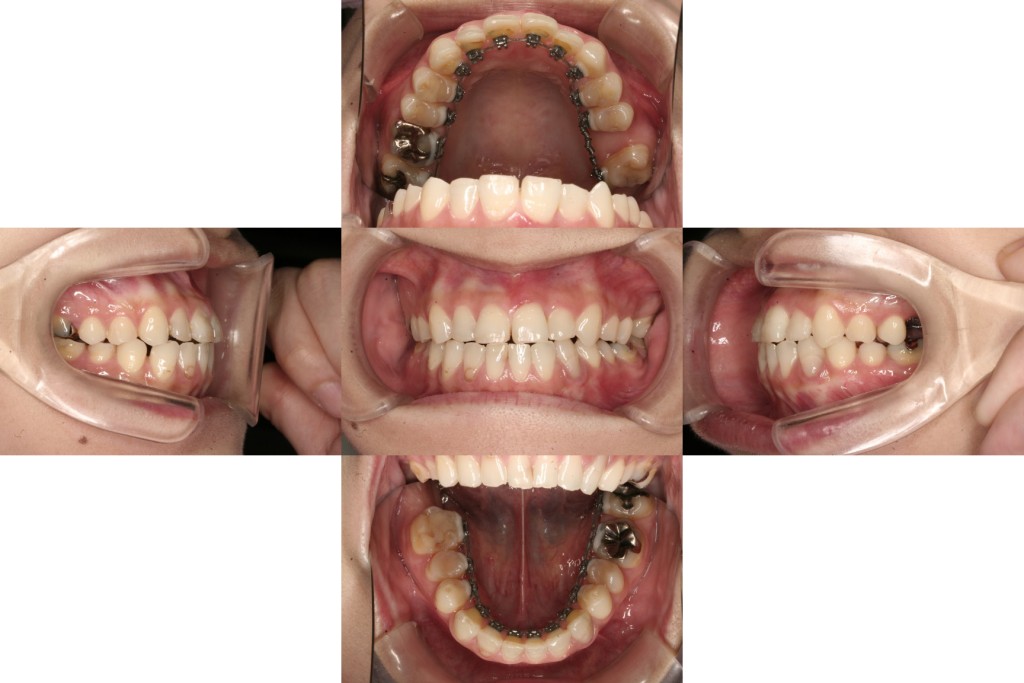 case16_インプラント併用_8ヶ月