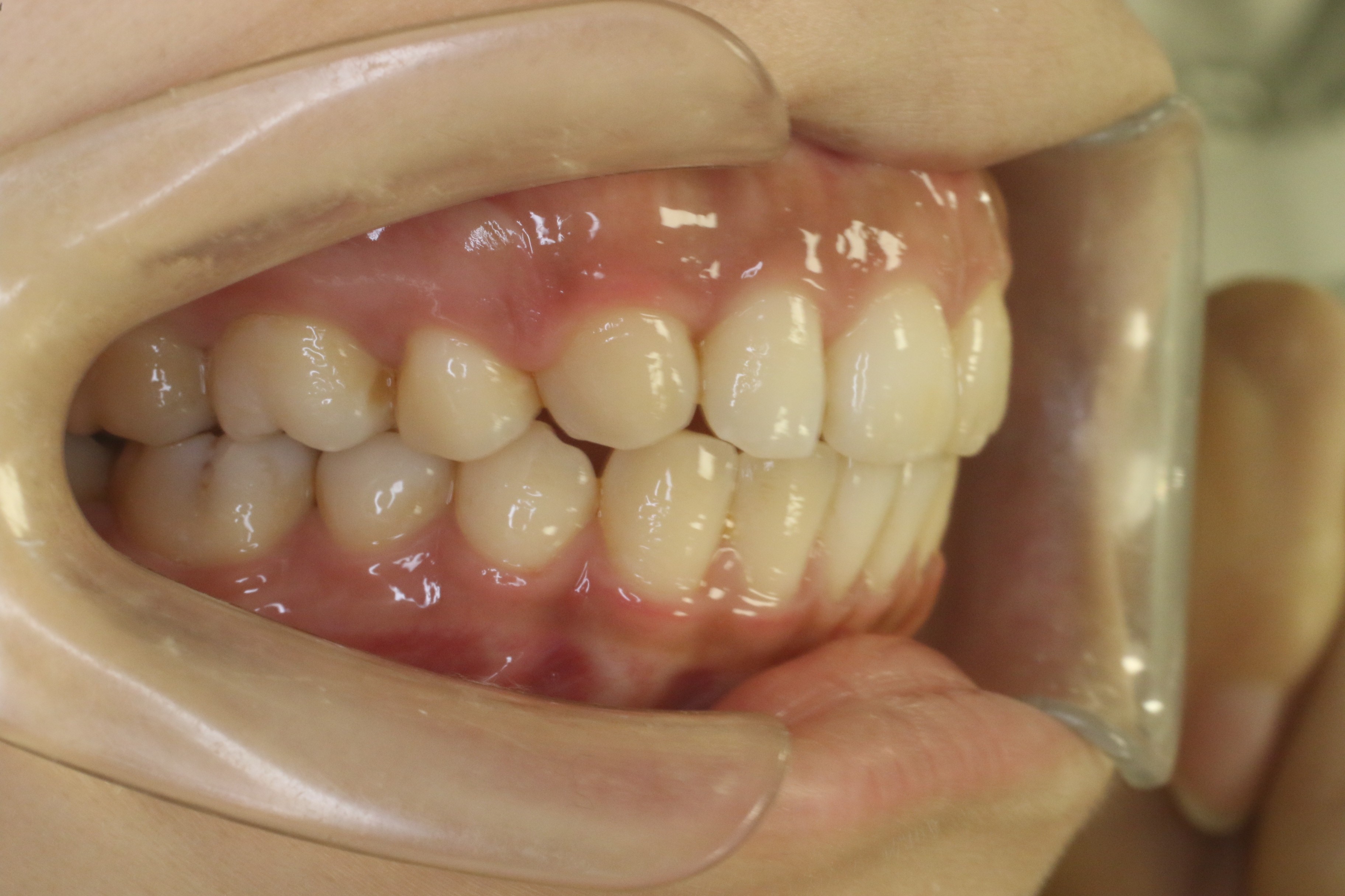 出っ歯・リンガル矯正の症例