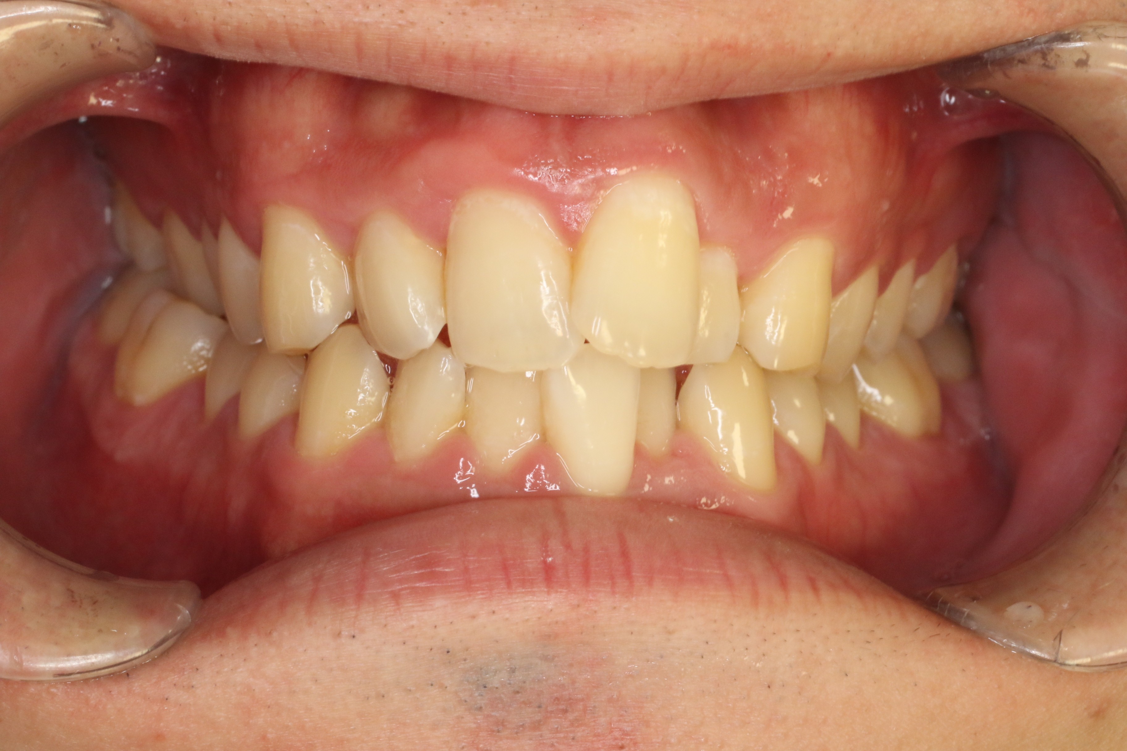 凸凹を改善したい・リンガル矯正の症例