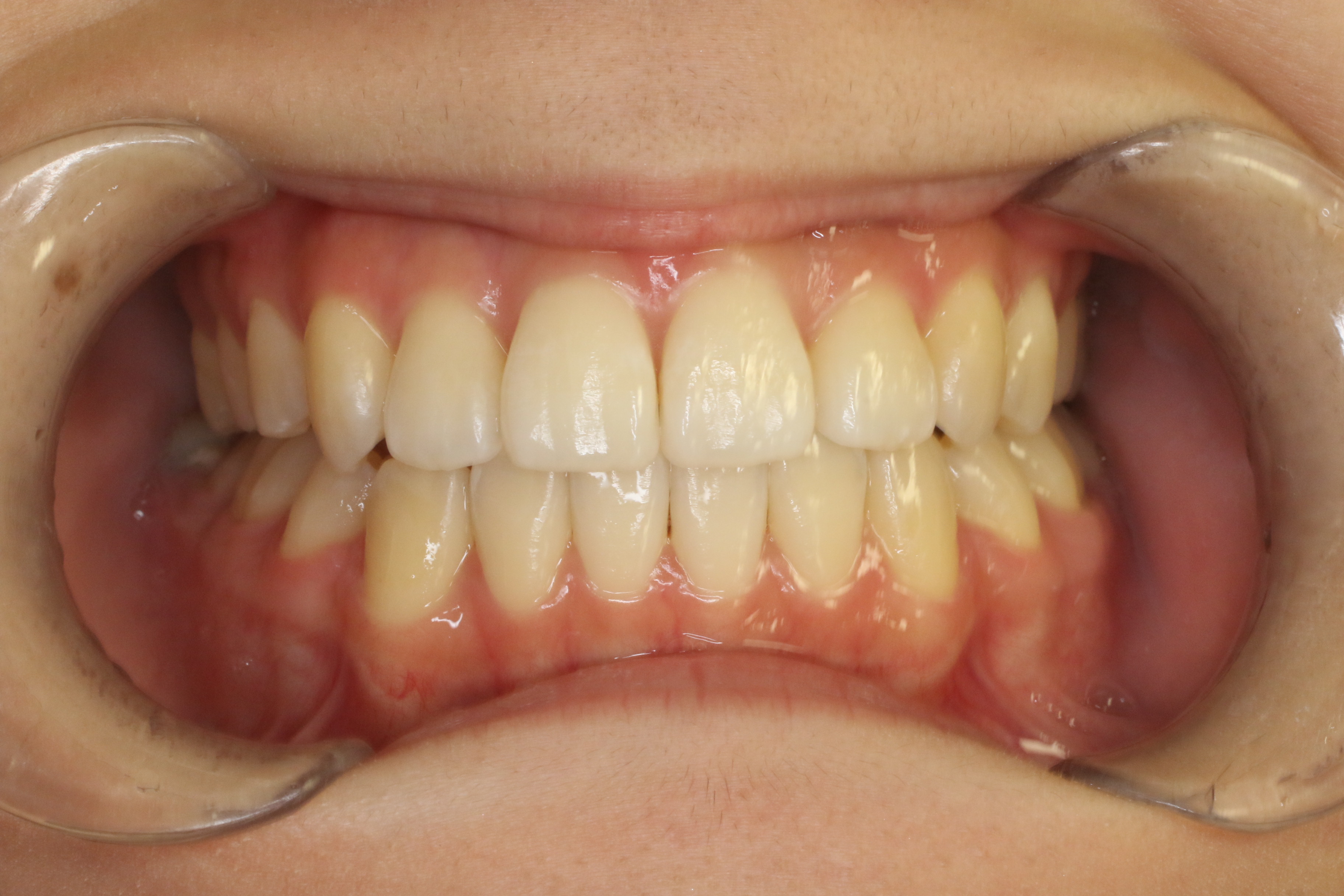 正中ズレ、Eライン整えたい・リンガル矯正の症例