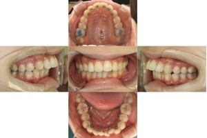 出っ歯・リンガル矯正の症例 