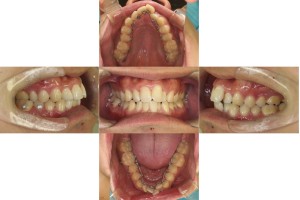 凸凹を改善したい・リンガル矯正の症例