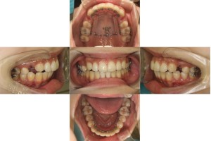 出っ歯・リンガル矯正の症例 