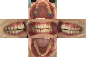 凸凹を改善したい・リンガルの症例