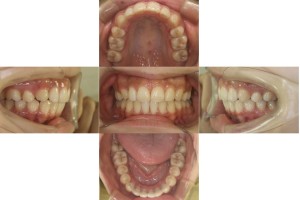 出っ歯・リンガル矯正の症例 