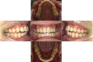 凸凹を改善したい・リンガル矯正の症例