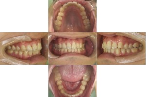 凸凹を改善したい・リンガル矯正の症例