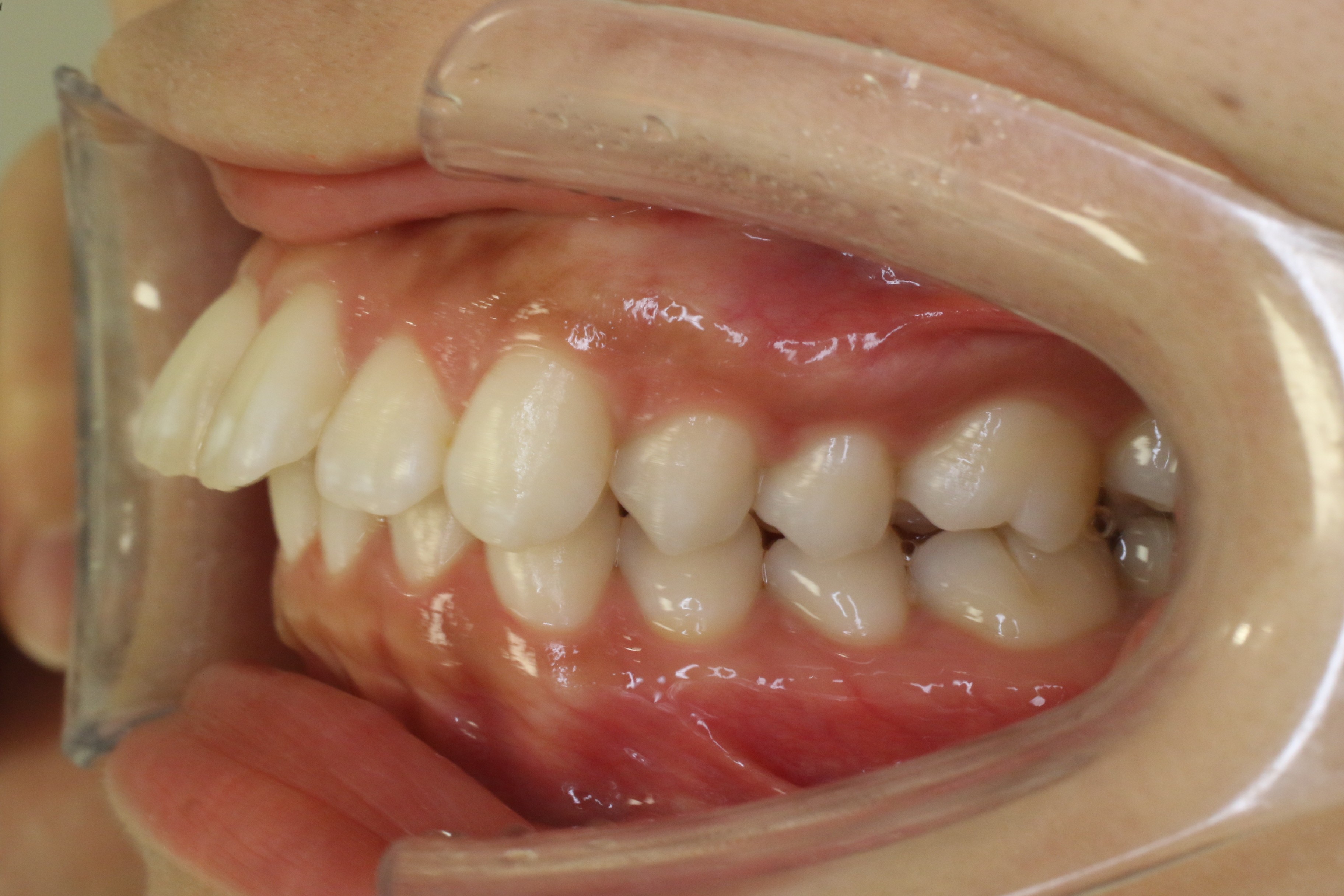 出っ歯を改善したい・リンガル矯正の症例