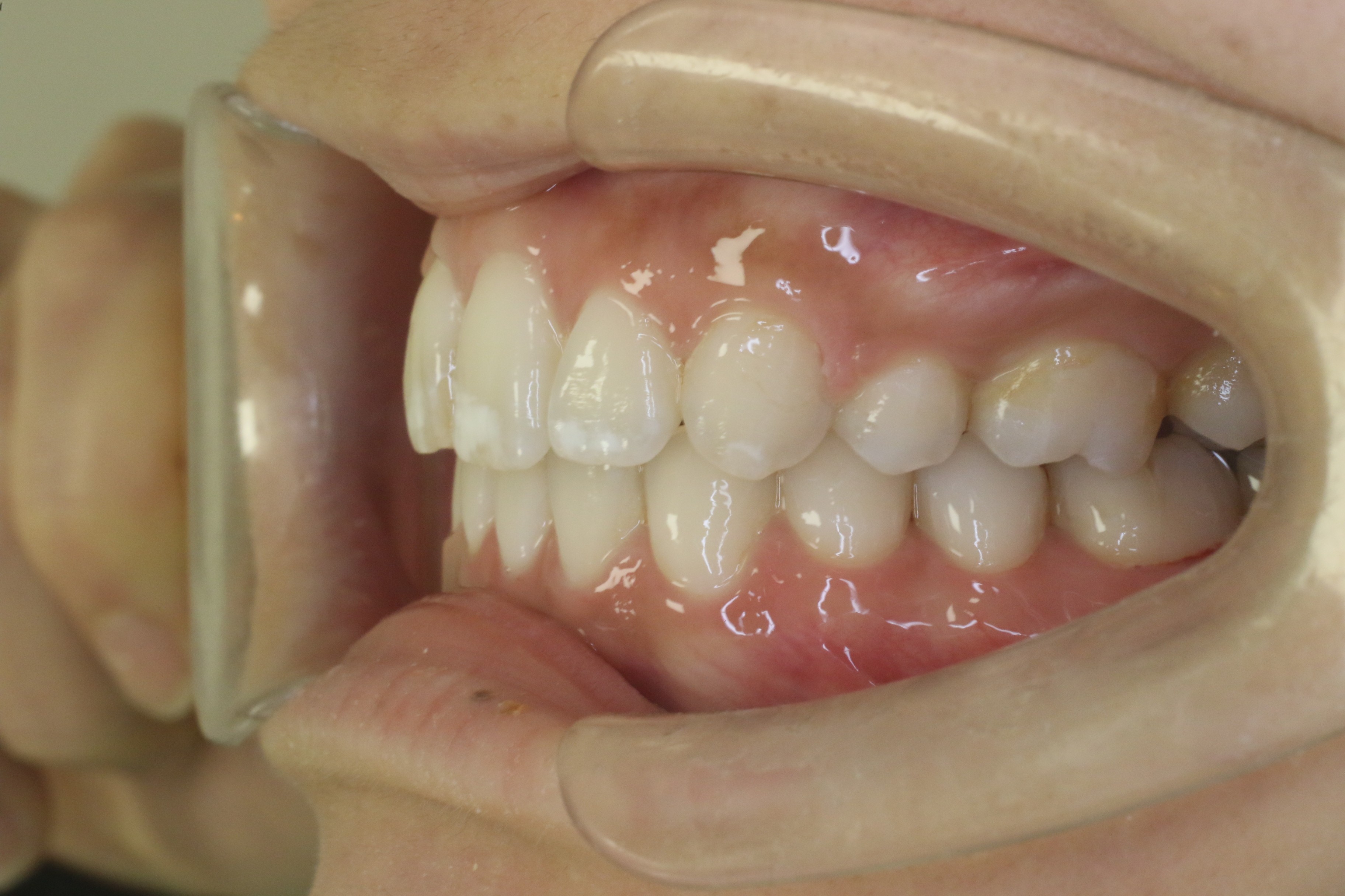 出っ歯を改善したい・リンガル矯正の症例