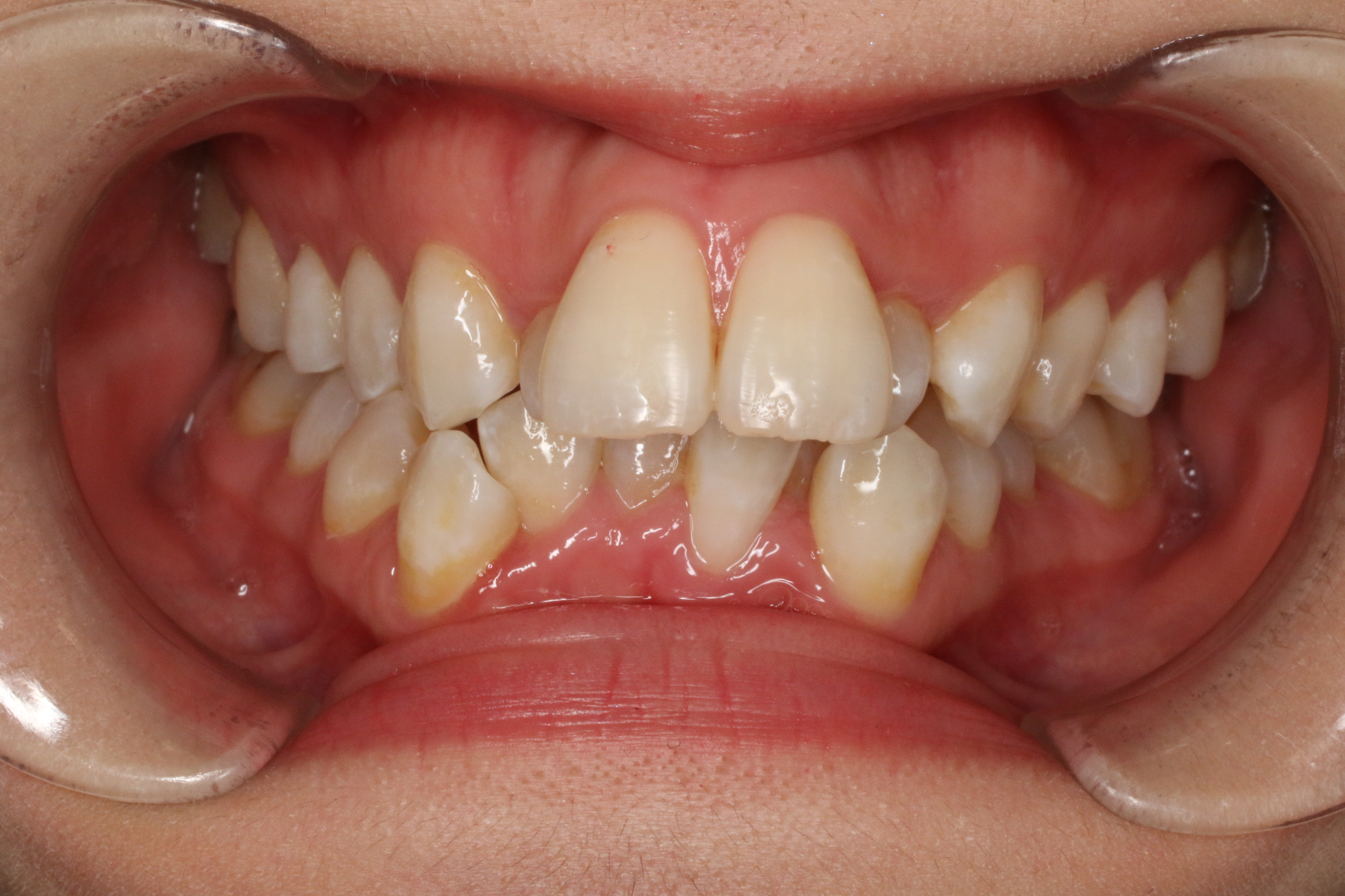 叢生・リンガル矯正の症例