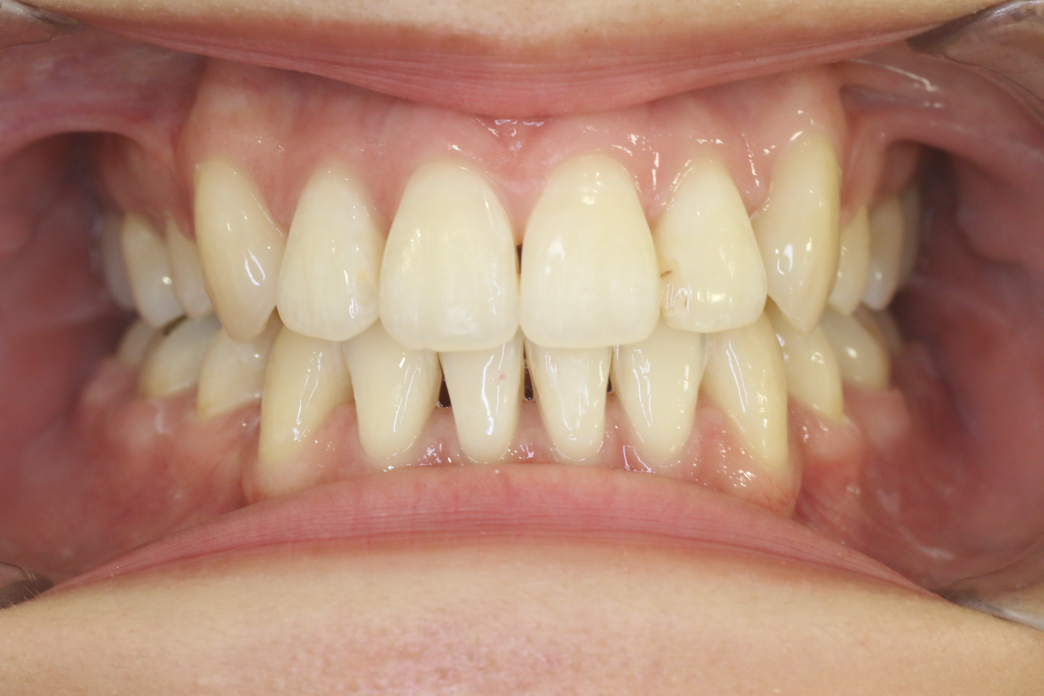 凸凹・リンガル矯正の症例