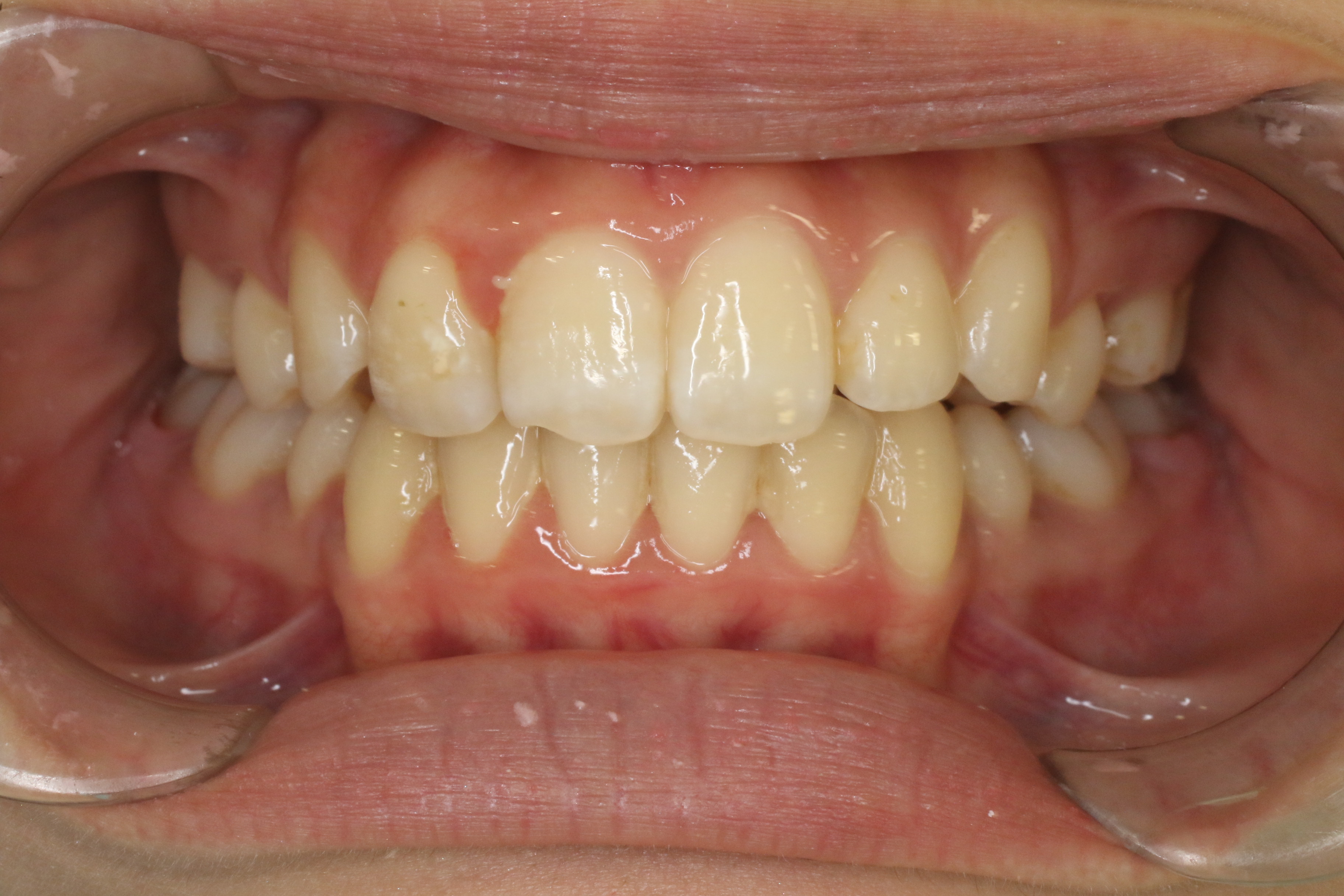 叢生・ハーフリンガルの症例