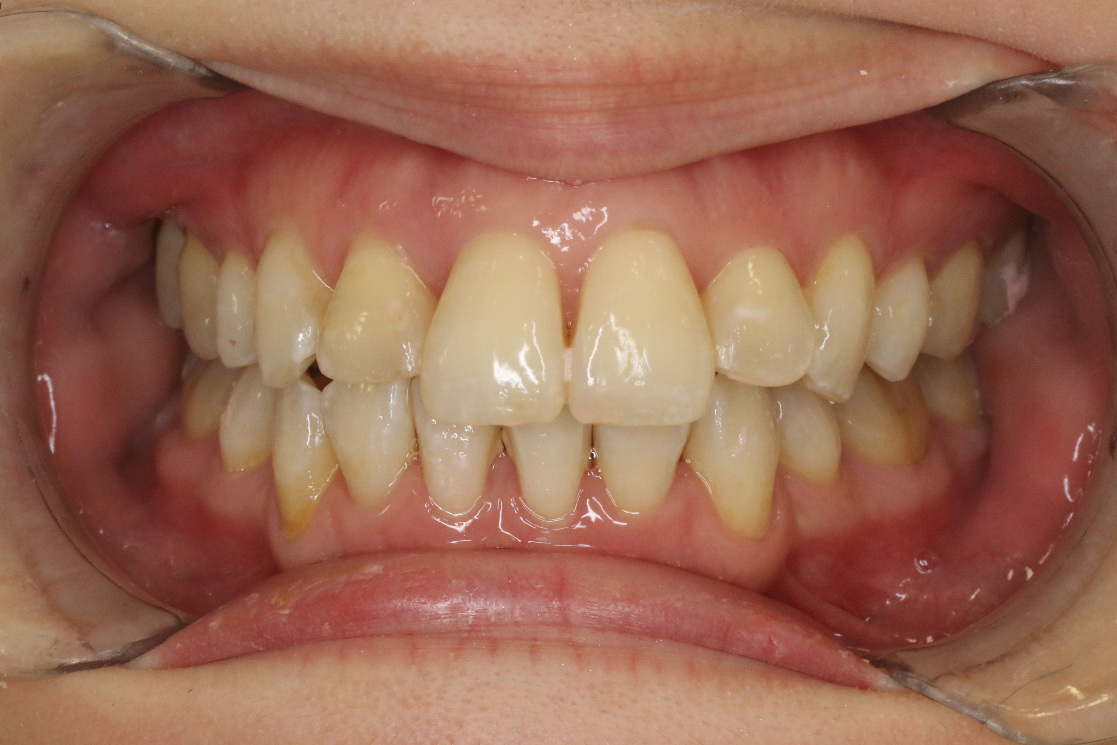 叢生・リンガル矯正の症例