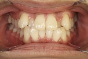 凸凹を改善したい・ハーフリンガルの症例