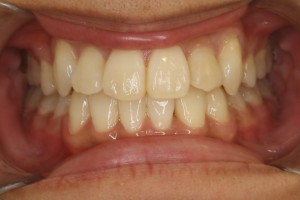 凸凹を改善したい・ハーフリンガルの症例