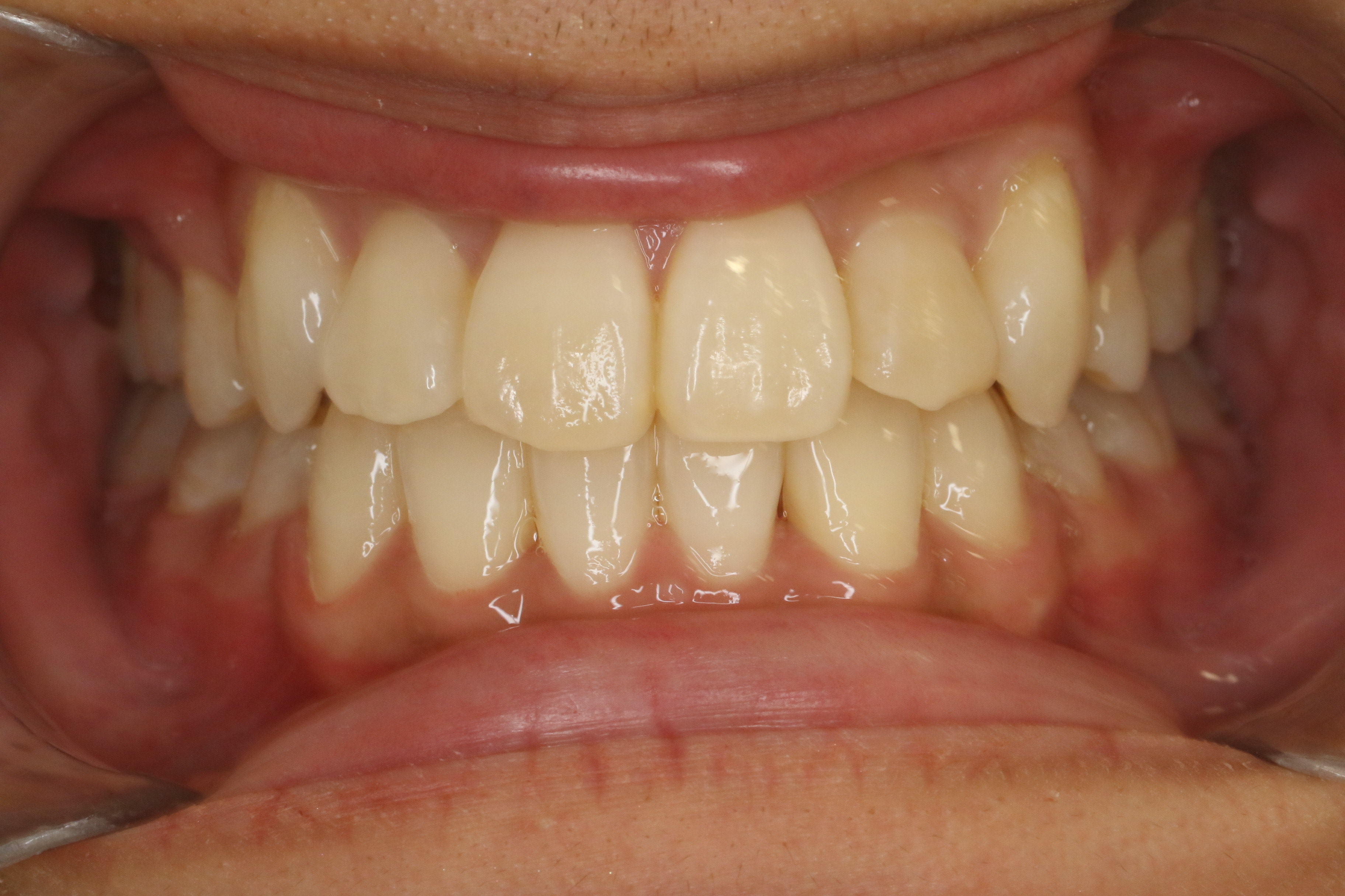 凸凹を改善したい・ハーフリンガルの症例