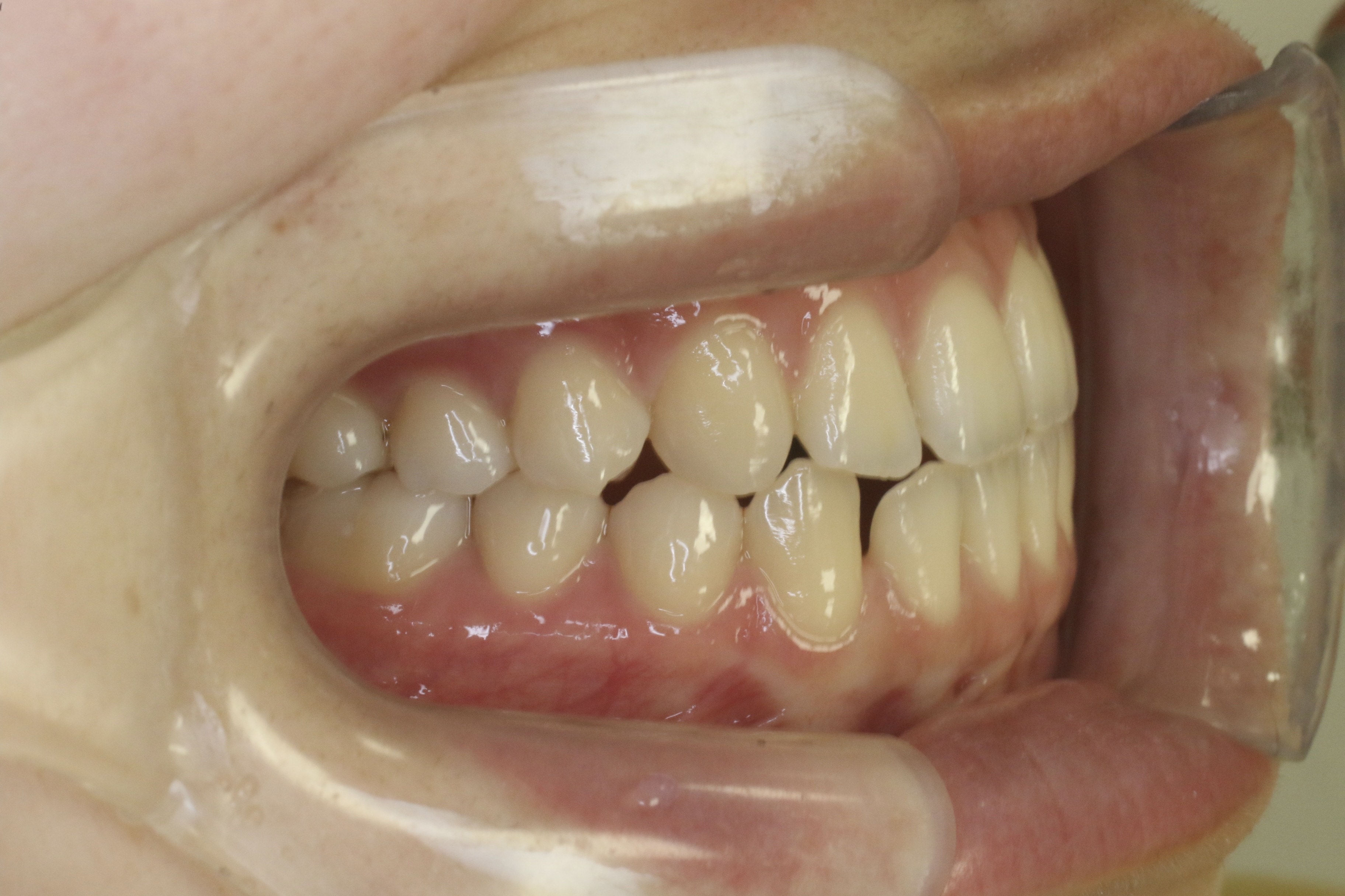 かみ合わせを治したい・リンガルの症例