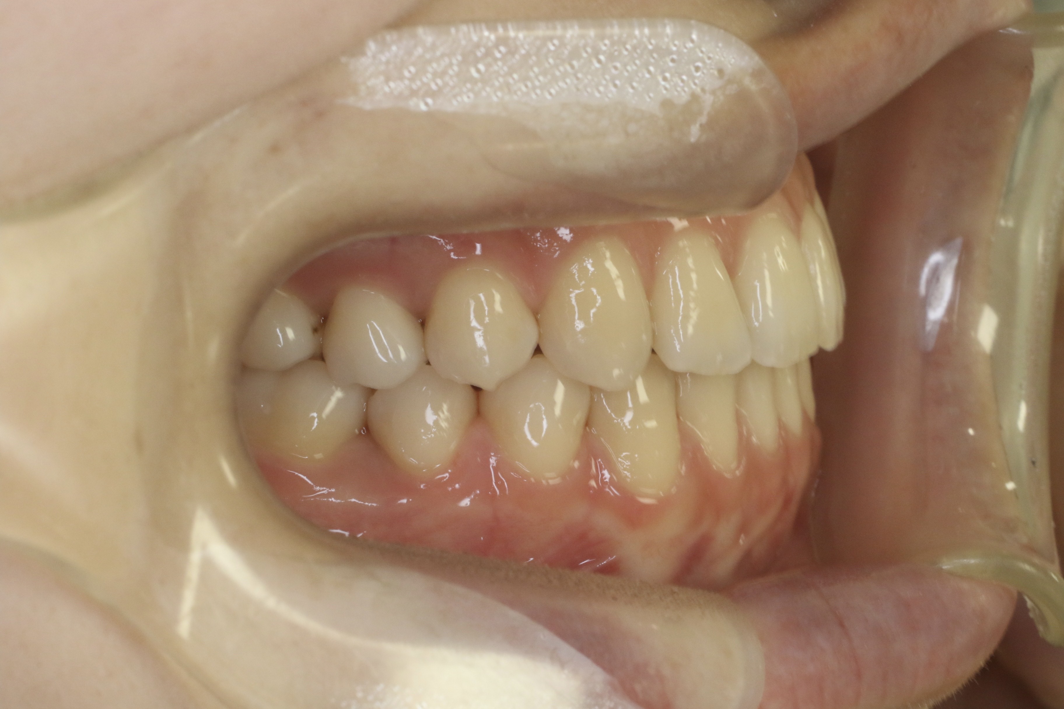 かみ合わせを治したい・リンガルの症例