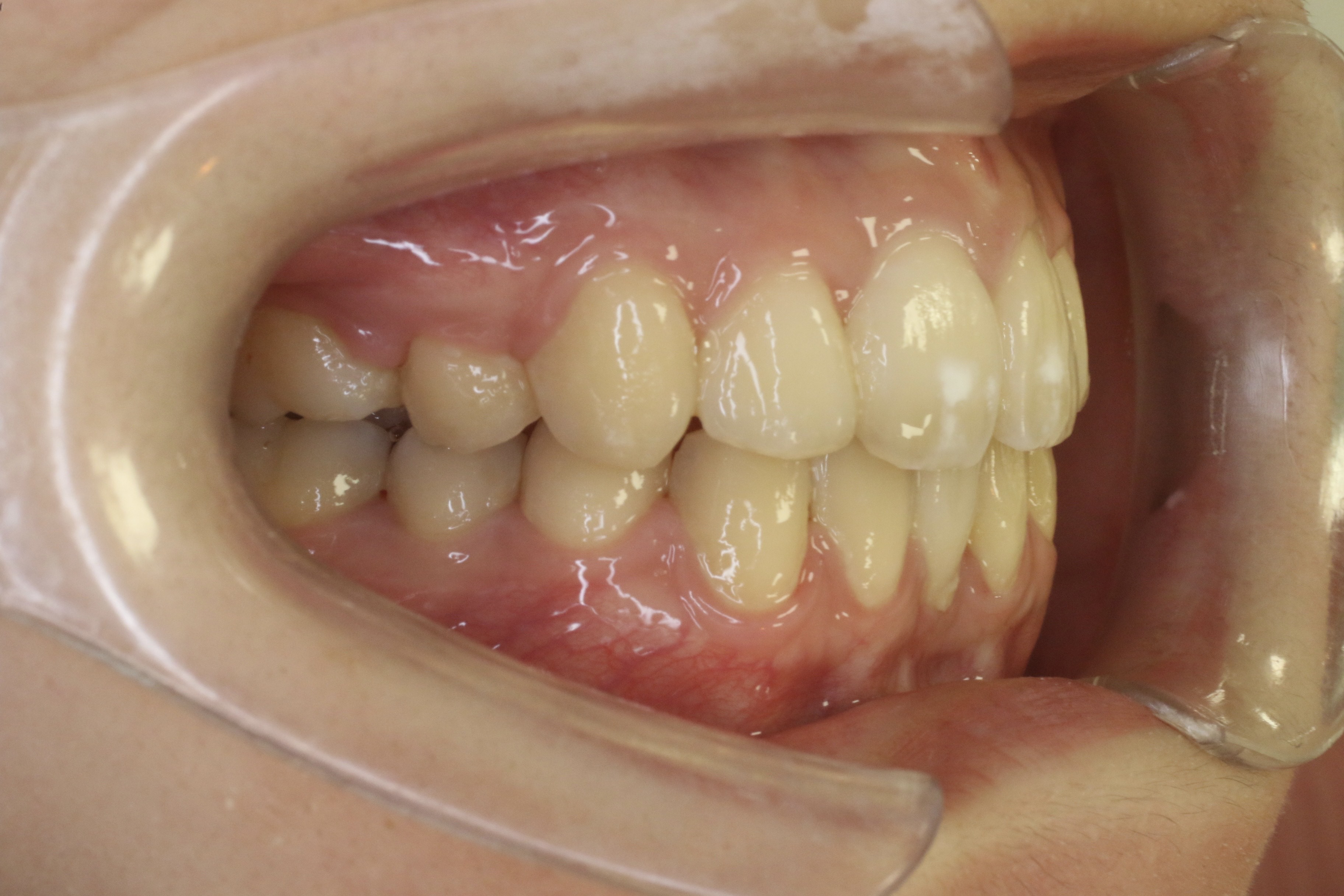 凸凹を治したい・リンガルの症例