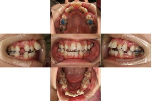 叢生・リンガル矯正の症例