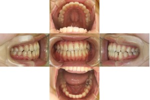 かみ合わせを治したい・リンガルの症例