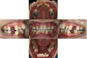 叢生・リンガル矯正の症例