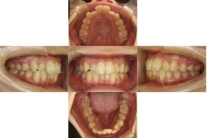 凸凹を治したい・リンガルの症例