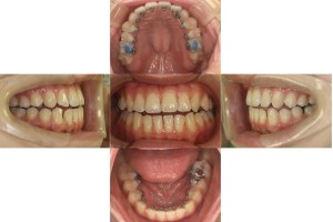 かみ合わせを治したい・リンガルの症例