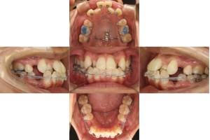 凸凹を改善したい・ハーフリンガルの症例