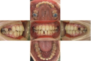 凸凹を治したい・リンガルの症例