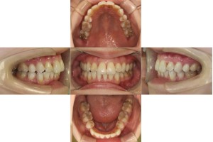 叢生・リンガル矯正の症例