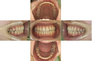 かみ合わせを治したい・リンガルの症例