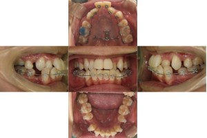 凸凹を改善したい・ハーフリンガルの症例