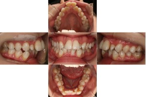 叢生・リンガル矯正の症例