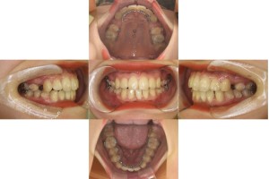 凸凹を治したい・リンガルの症例