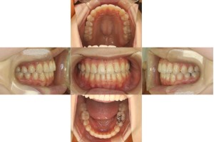 かみ合わせを治したい・リンガルの症例