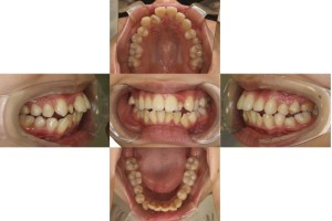 叢生・ハーフリンガルの症例