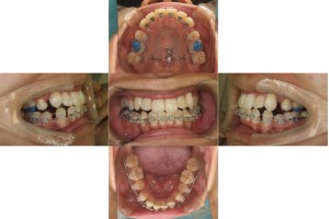 凸凹を改善したい・ハーフリンガルの症例