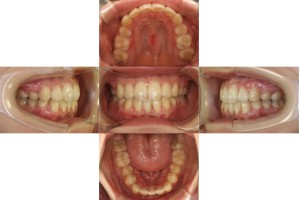 凸凹を治したい・リンガルの症例