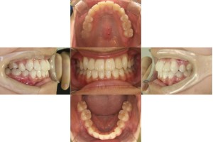 凸凹を改善したい・ハーフリンガルの症例