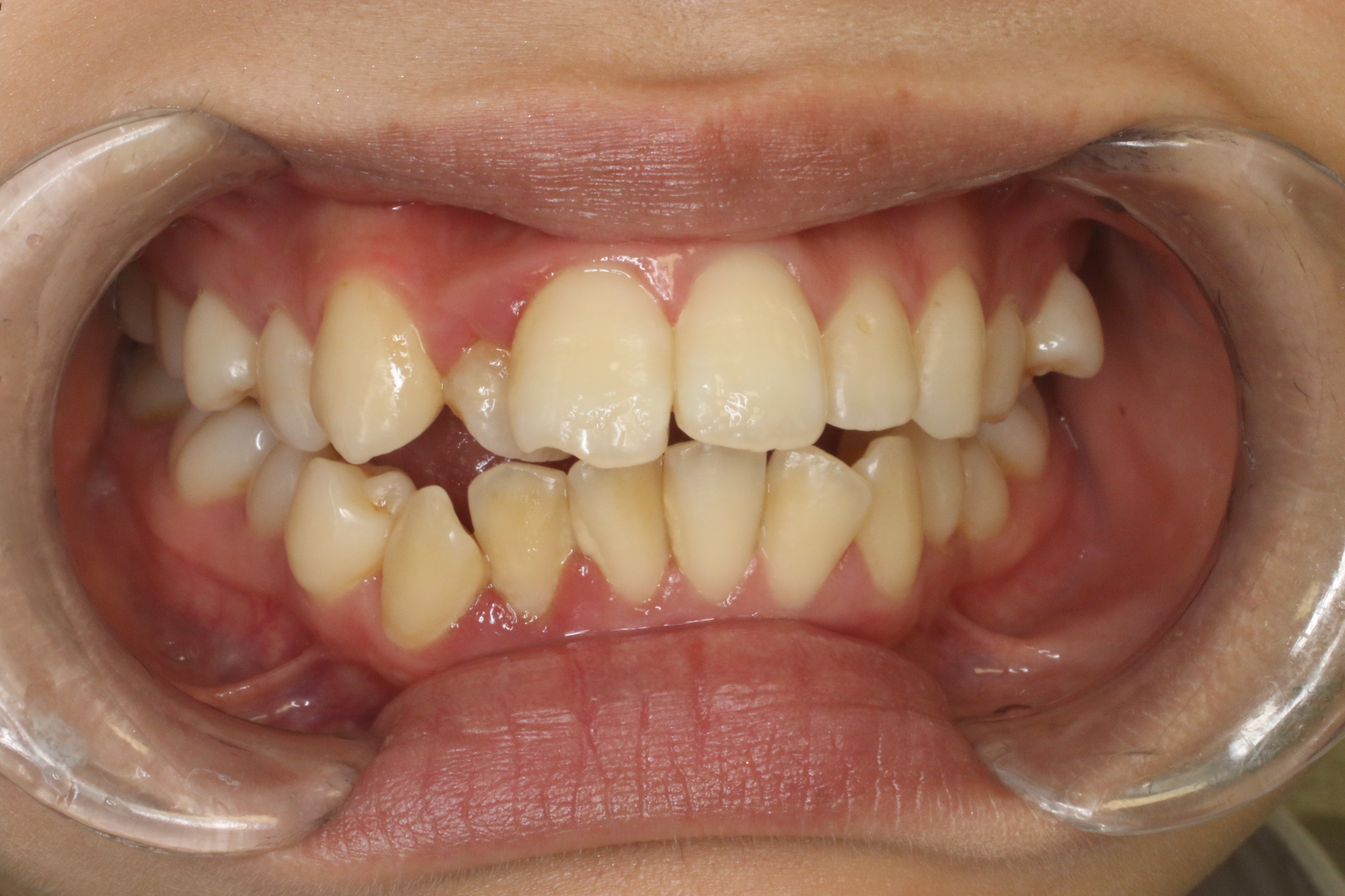 叢生・ハーフリンガルの症例