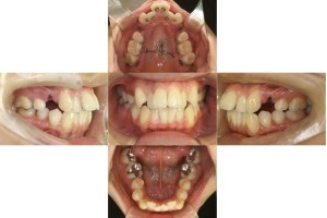 凸凹・リンガル矯正の症例