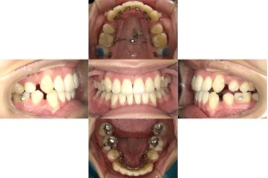 凸凹・リンガル矯正の症例