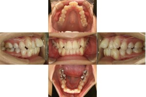 凸凹・リンガル矯正の症例