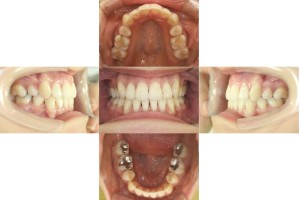 凸凹・リンガル矯正の症例